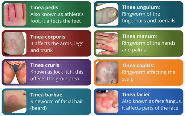 how to treat ringworm in human scalp