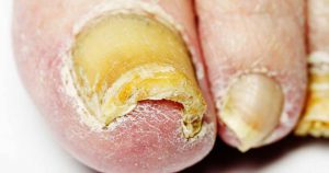 How to Get Rid of Nail Fungus