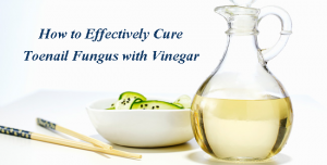 White Vinegar for Nail Fungus