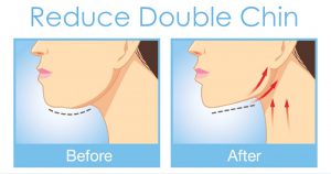 Exercise to Reduce Double Chin Before After