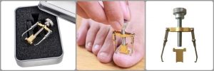 Ingrown Toenail Correction Tool