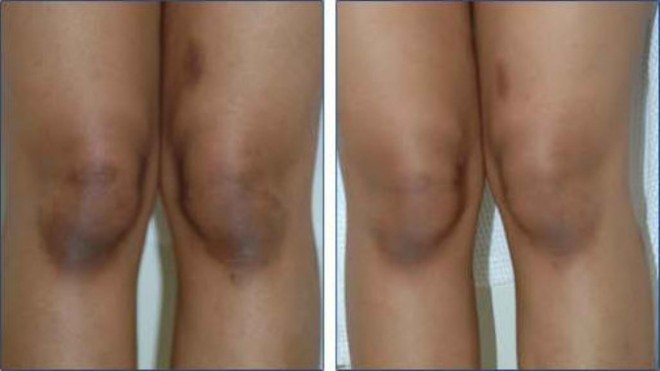 How to Lighten Dark Knees