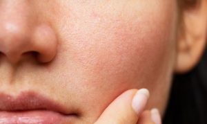 How to get rid of red spots on Skin